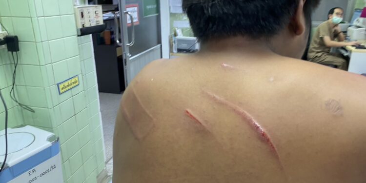 นนทบุรี หนุ่มวัย 20 ปี ถูกเพื่อนเก่ายกพวกมารุมฟันบาดเจ็บ เหตุไม่พอใจยืมรถจยย.ไม่เติมน้ำมัน