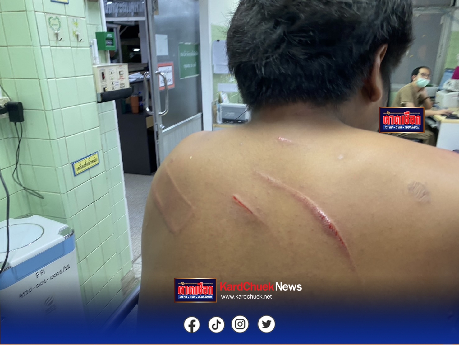 นนทบุรี หนุ่มวัย 20 ปี ถูกเพื่อนเก่ายกพวกมารุมฟันบาดเจ็บ เหตุไม่พอใจยืมรถจยย.ไม่เติมน้ำมัน